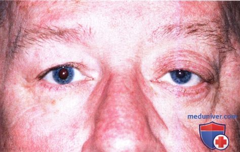 Нейрофиброма глазницы