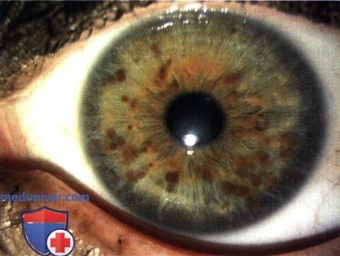 Нейрофиброма сосудистой оболочки глаза