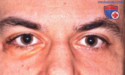 Некробиотическая ксантогранулема глазницы