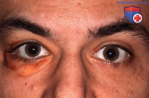 Некробиотическая ксантогранулема века глаза при парапротеинемии
