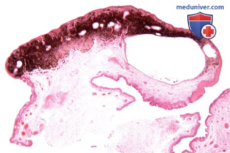 Меланоцитарный невус конъюнктивы