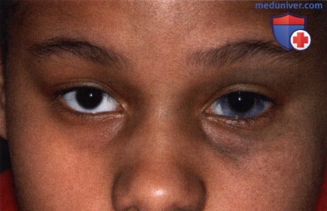 Окулодермальный меланоцитоз (невус Ота) века глаза