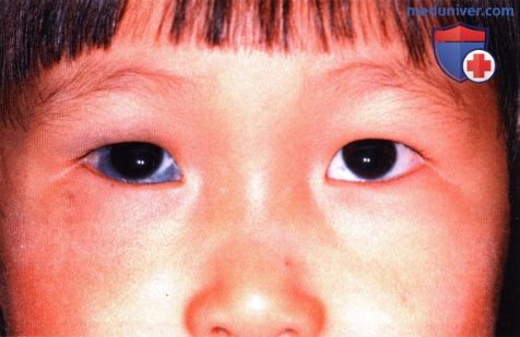 Окулодермальный меланоцитоз (невус Ота) века глаза
