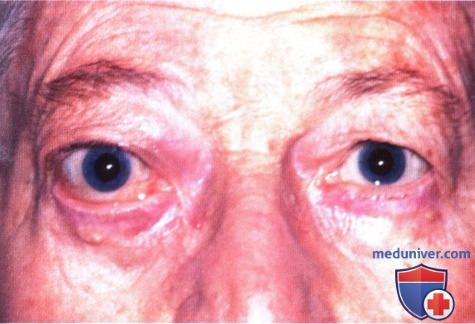 Неходжкинская лимфома глазницы