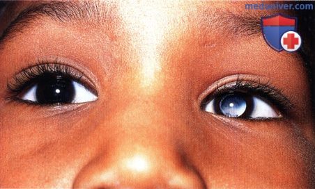 Примеры офтальмотоксокароза симулирующего ретинобластому