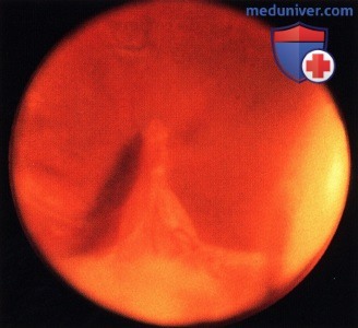 Примеры офтальмотоксокароза симулирующего ретинобластому