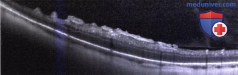 Оптическая когерентная томография (ОКТ) комбинированной гамартомы сетчатки и пигментного эпителия