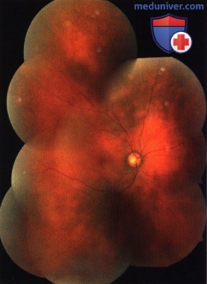 Примеры оптической когерентной томографии (ОКТ) лимфомы сосудистой оболочки глаза