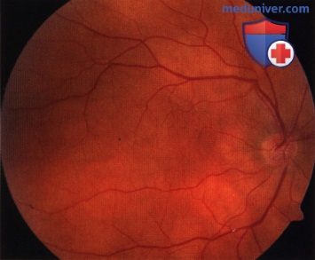 Примеры оптической когерентной томографии (ОКТ) лимфомы сосудистой оболочки глаза