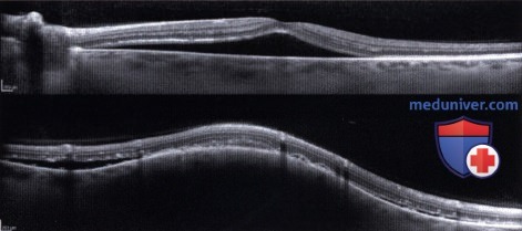 Примеры оптической когерентной томографии (ОКТ) при меланоме хориоидеи
