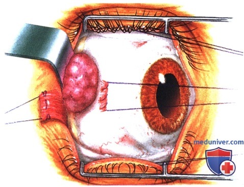 Операции при опухоли глазницы: варианты хирургического лечения