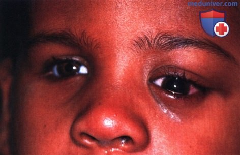 Остеосаркома глазницы (остеогенная саркома глазницы)