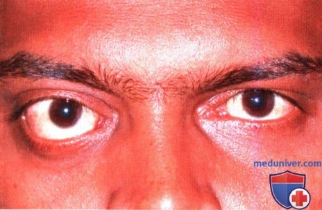 Паразитарная киста глазницы