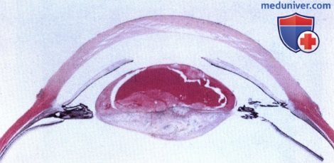 Примеры персистирующего первичного гиперпластического стекловидного тела (PHPV; персистирующей эмбриональной сосудистой сети, PFV) симулирующего ретинобластому