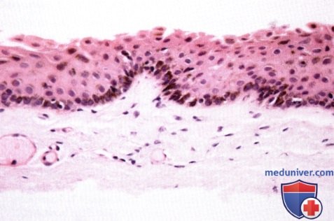 Первичный приобретенный меланоз конъюнктивы (primary acquired melanosis, PAM)