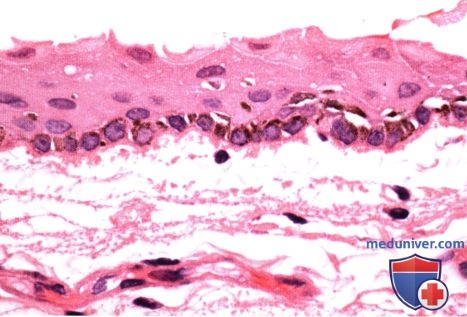 Первичный приобретенный меланоз конъюнктивы (primary acquired melanosis, PAM)