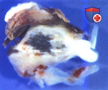 Примеры пигментной злокачественной медуллоэпителиомы цилиарного тела