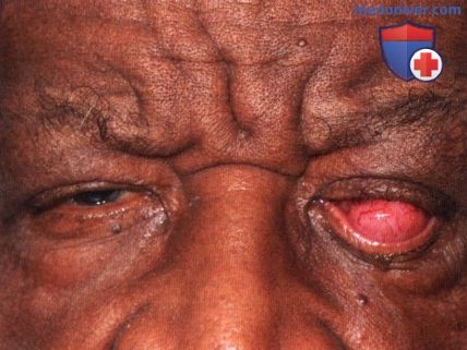 Плазмобластная лимфома глазницы
