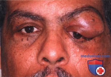 Плазмоцитома и лимфоплазмоцитоидная опухоль глазницы