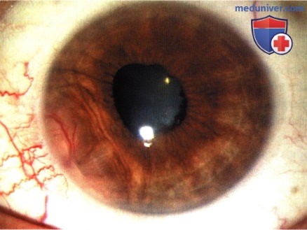 Плазмоцитома сосудистой оболочки глаза
