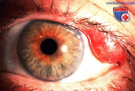 Плазмоцитома века глаза