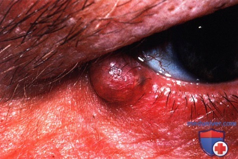 Плеоморфная аденома века глаза