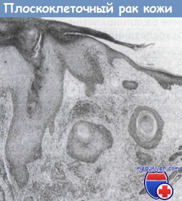 Гистология плоскоклеточного рака кожи