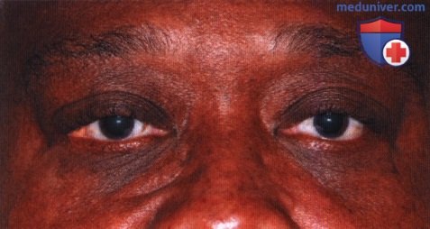 Пролапс жировой клетчатки глазницы