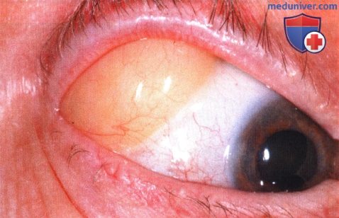 Пролапс жировой клетчатки глазницы