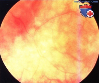 Примеры прорастающей в глазницу лимфомы сосудистой оболочки глаза