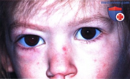 Злокачественная рабдоидная опухоль глазницы