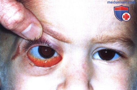 Злокачественная рабдоидная опухоль глазницы