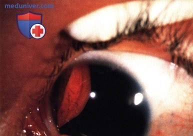 Рабдомиосаркома сосудистой оболочки глаза