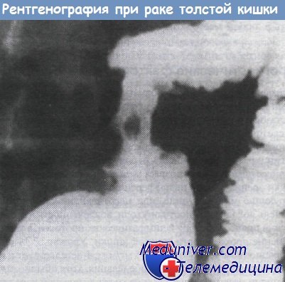 Рентгенография при раке толстой кишки