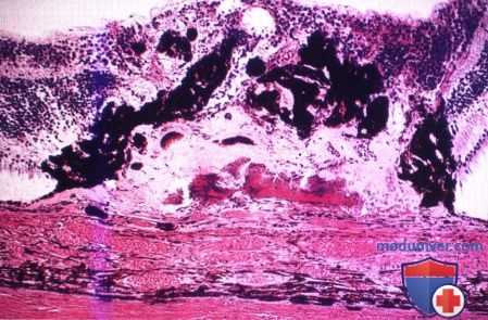 Псевдонеопластическая реактивная гиперплазия пигментного эпителия сетчатки