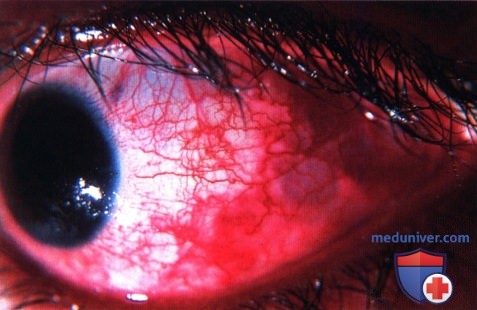 Альвеолярная мягкотканная саркома глазницы