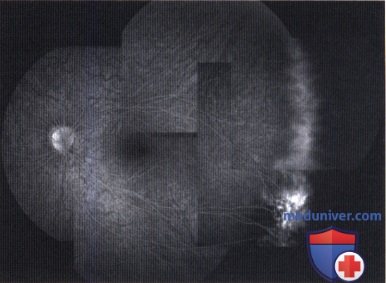 Примеры семейной эксудативной витриоретинопатии симулирующей ретинобластому