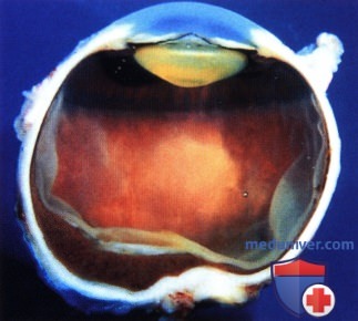 Шваннома (неврилеммома) сосудистой оболочки глаза