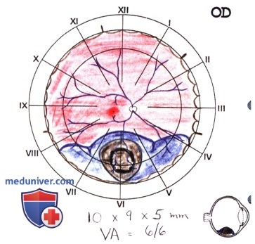 Пример местной резекции меланомы хориоидеи методом частичной послойной склерохориоидэктомии
