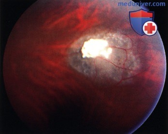 Примеры стабилизировавшейся и регрессировавшей ретинобластомы (ретиноцитомы)