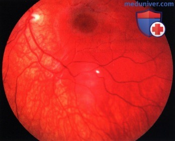 Примеры стабилизировавшейся и регрессировавшей ретинобластомы (ретиноцитомы)