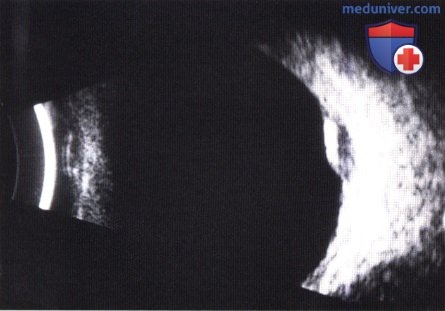 Примеры аргонлазерной фотокоагуляции (транспупиллярной термотерапии) меланомы хориоидеи