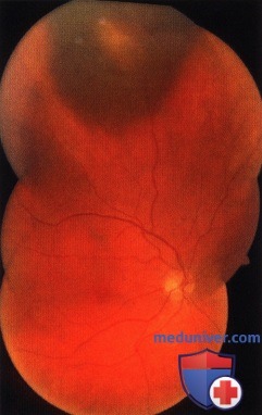 Примеры аргонлазерной фотокоагуляции (транспупиллярной термотерапии) меланомы хориоидеи