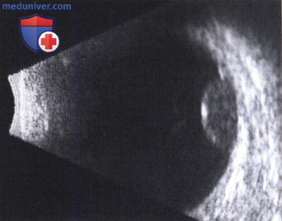 Примеры УЗИ меланомы хориоидеи после лучевой терапии с аппликатором