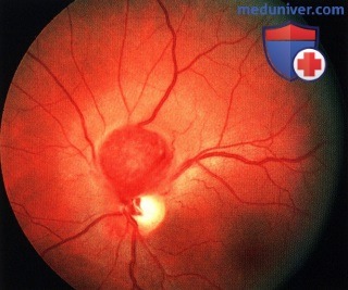 Примеры узловой гемангиобластомы диска зрительного нерва