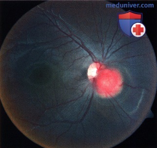 Примеры узловой гемангиобластомы диска зрительного нерва