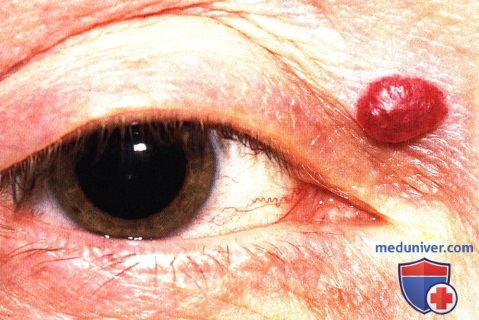 Приобретенная гемангиома (вишневая гемангиома, старческая гемангиома) века глаза