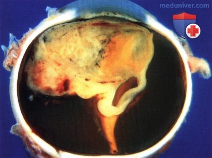 Врожденные новообразования беспигментного эпителия цилиарного тела (внутриглазная медуллоэпителиома)