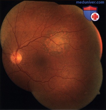Врожденный глазной меланоцитоз