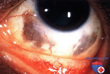 Врожденный глазной меланоцитоз